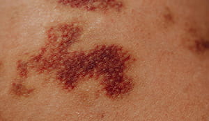 Doenças de pele | Caso os fumos de solda entrem em contato direto com a pele os soldadores podem contrair algumas doenças como: queimadura; dermatites: coceiras, inchaços, vermelhidão; hiperpigmentação: manchas escuras | Nederman