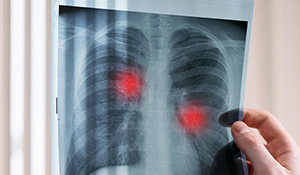 Doenças respiratórias | Por ficarem suspensos nos ambientes dos fumos de solda provocam doenças respiratórias como: pneumonia do soldador; asma; fibrose pulmonar | Saiba mais com a Nederman