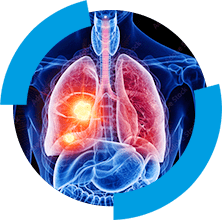 Explosão por poeira combustível